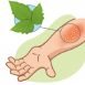 How to Cure Poison IVY Naturally?