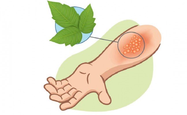How to Cure Poison IVY Naturally? How to Cure Poison IVY Naturally?
