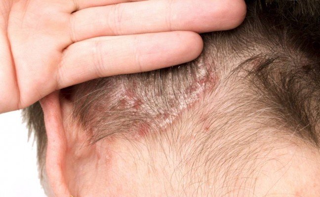 How to Cure Psoriasis of the Skin Naturally?