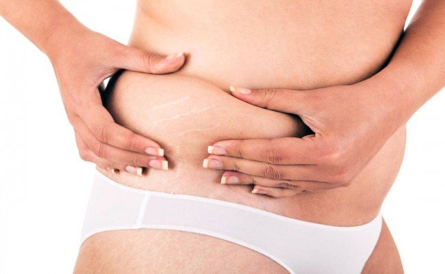 How to Cure Stretch Marks at Home Naturally? How to Cure Stretch Marks at Home Naturally?