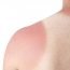 How to Cure Sunburn at Home Naturally?
