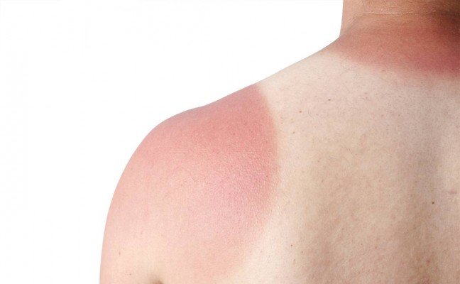 How to Cure Sunburn at Home Naturally? How to Cure Sunburn at Home Naturally?