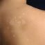 How to Cure Tinea Versicolor at Home Naturally?