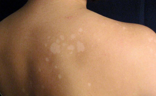 How to Cure Tinea Versicolor at Home Naturally?