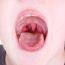 How to Cure Tonsillitis at Home Naturally?