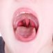 How to Cure Tonsillitis at Home Naturally?