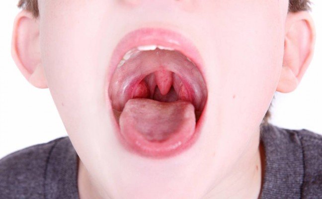 How to Cure Tonsillitis at Home Naturally?