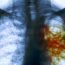 How to Cure Tuberculosis at Home Naturally?