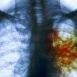 How to Cure Tuberculosis at Home Naturally?