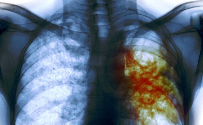 How to Cure Tuberculosis at Home Naturally?