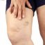 How to Cure Varicose Veins at Home Naturally?