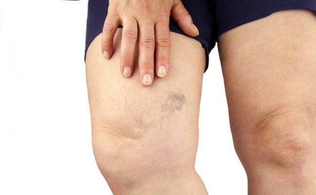 How to Cure Varicose Veins at Home Naturally? How to Cure Varicose Veins at Home Naturally?