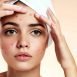 How to get rid of Acne at Home Naturally?
