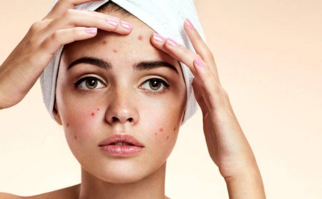 How to get rid of Acne at Home Naturally? How to get rid of Acne at Home Naturally?