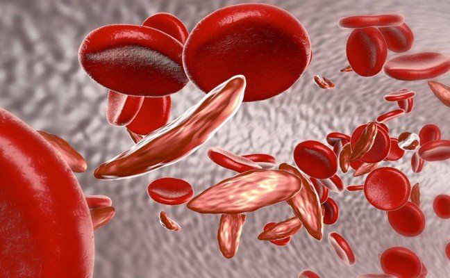 How to get rid of Anaemia at Home Naturally?