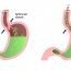 How to get rid of Belching at Home Naturally?