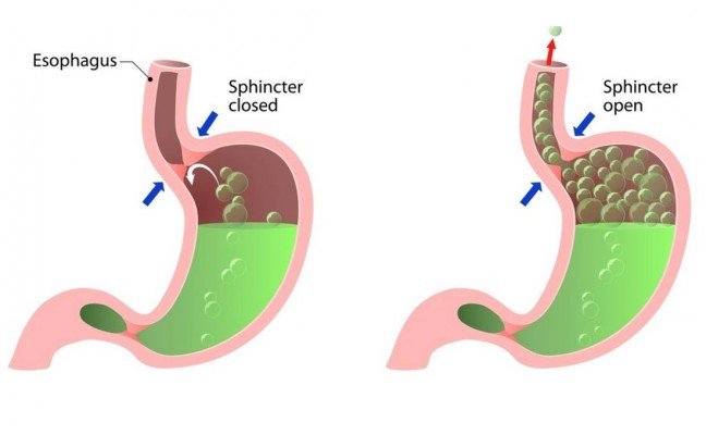 How to get rid of Belching at Home Naturally? How to get rid of Belching at Home Naturally?