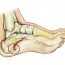 How to get rid of Bone Spurs at Home Naturally?