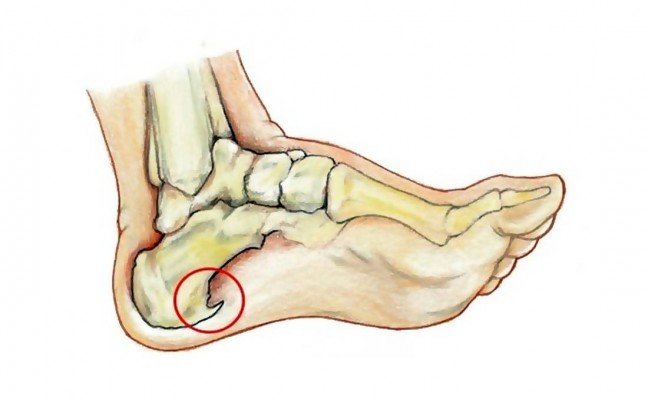 How to get rid of Bone Spurs at Home Naturally?