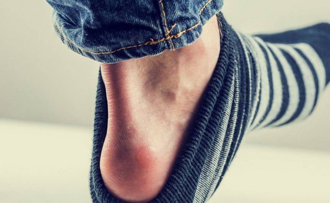 How to Get Rid of Chafing at Home Naturally?