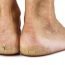 How to get rid of Cracked Heels at Home Naturally?