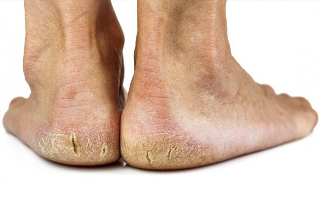 How to get rid of Cracked Heels at Home Naturally? How to get rid of Cracked Heels at Home Naturally?
