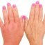 How to get rid of Dropsy at Home Naturally?