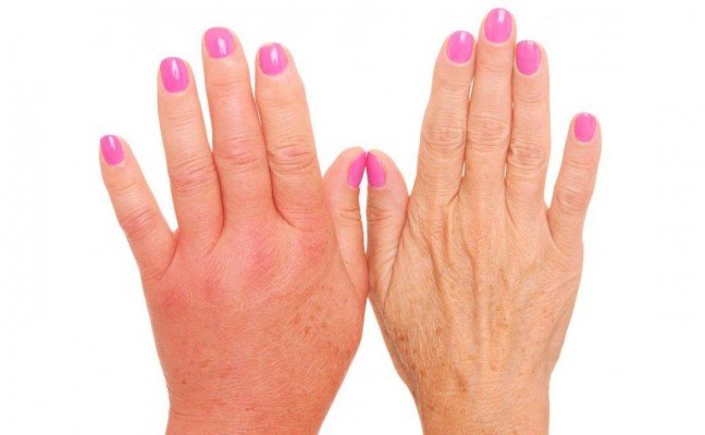 How to get rid of Dropsy at Home Naturally?