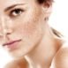 How to get rid of Freckles at Home Naturally?