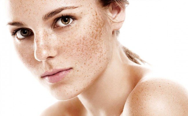 How to get rid of Freckles at Home Naturally?
