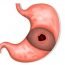 How to get rid of Gastritis at Home Naturally?