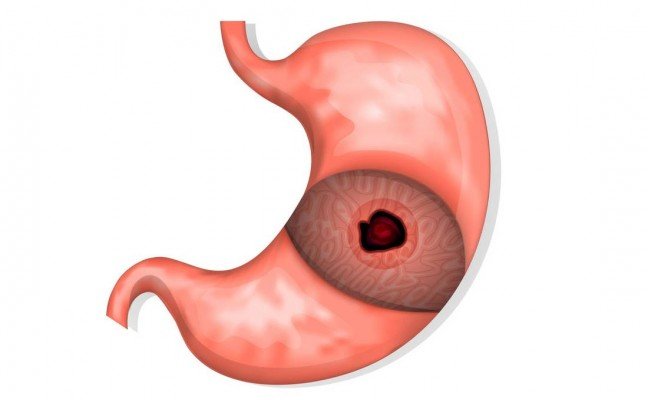 How to get rid of Gastritis at Home Naturally?