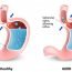 How to get rid of Gastroesophageal Reflux Disease (GERD) at Home Naturally?