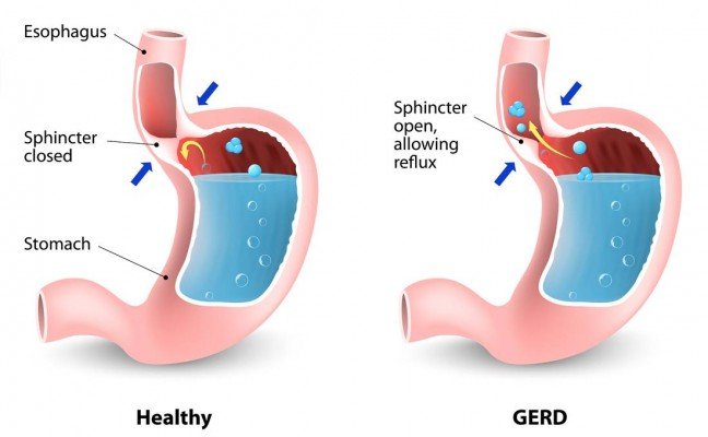 How to get rid of Gastroesophageal Reflux Disease (GERD) at Home Naturally? How to get rid of Gastroesophageal Reflux Disease (GERD) at Home Naturally?