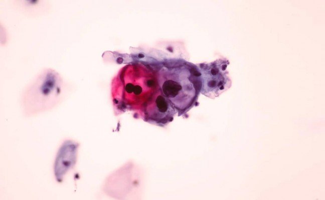 How to get rid of Genital Warts at Home Naturally?