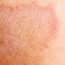 How to get rid of Jock Itch at Home Naturally?