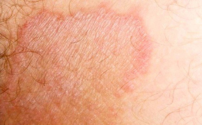 How to get rid of Jock Itch at Home Naturally? How to get rid of Jock Itch at Home Naturally?