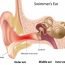 How to Get Rid of Swimmers Ear at Home Naturally?