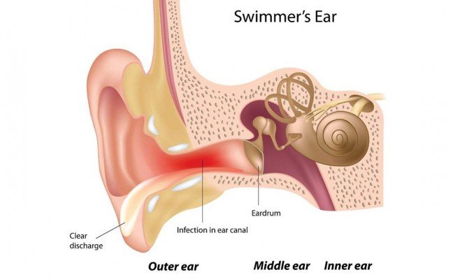 How to Get Rid of Swimmers Ear at Home Naturally? How to Get Rid of Swimmers Ear at Home Naturally?