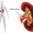 How to Remove Kidneys Stones Naturally?