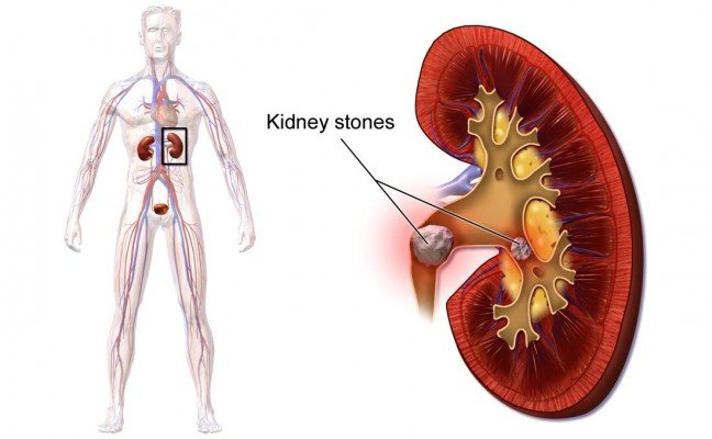 How to Remove Kidneys Stones Naturally?