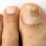 How to Treat Nail Fungus Infection at Home Naturally?