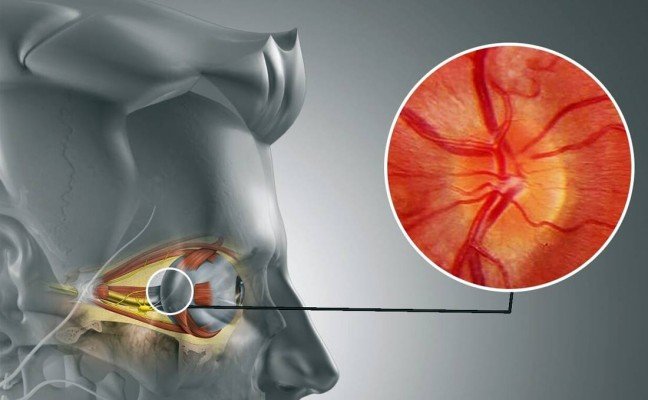 How to Treat Neuritis at Home Naturally?