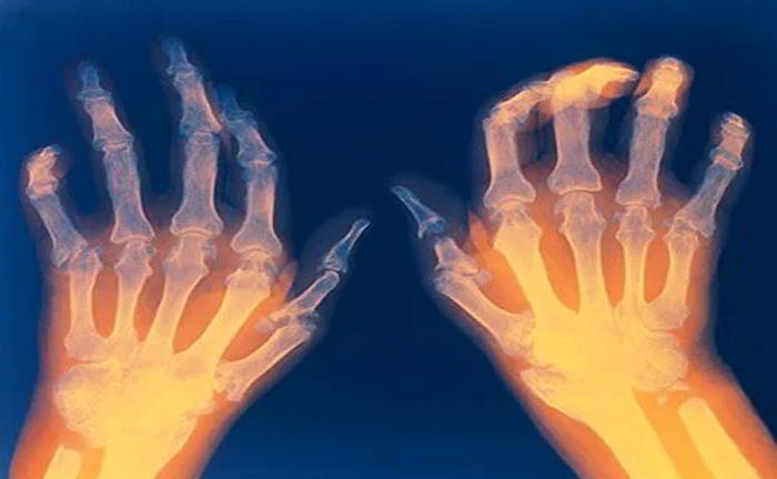 I am taking medicines for my arthritis but I have observed that because of it, my stomach remains upset, why is to so?