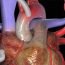 I am to undergo coronary by pass. What exactly is that?