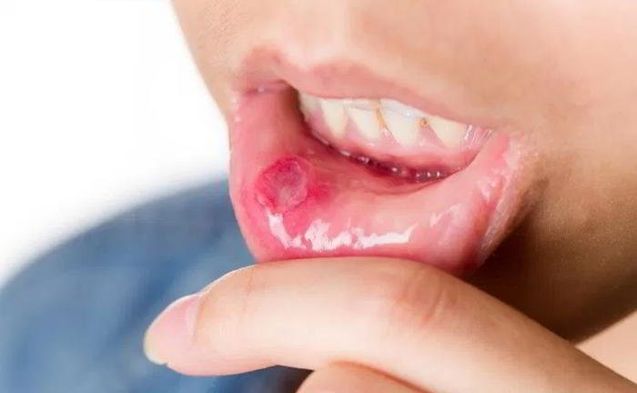 I fear I have an ulcer. How can I be sure of it?