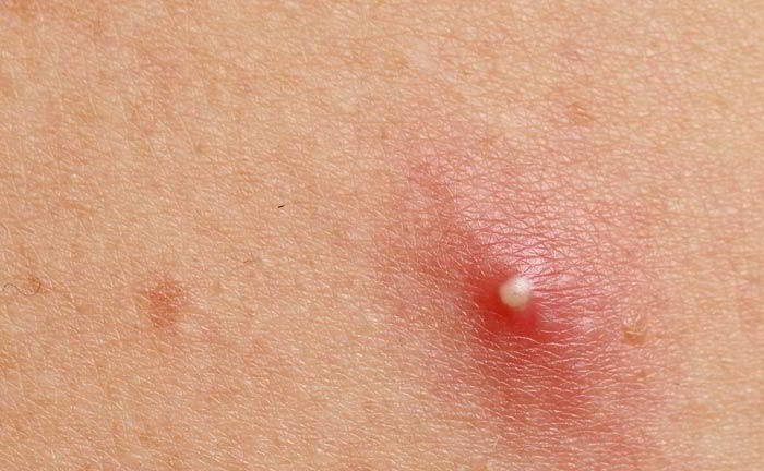 I have a wart on the skin out side the vagina what can done about it ?