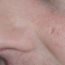 I have 'rodent ulcer' on my face. What is it?