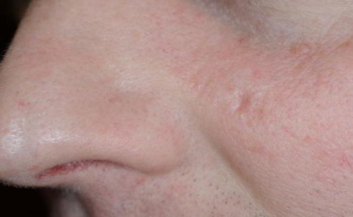 I have 'rodent ulcer' on my face. What is it?