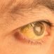 I have yellow patches around my eyes. What is the problem?